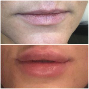 увеличение губ фото до и после