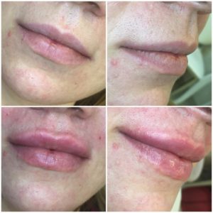 губы гиалуроновая кислота до и после фото