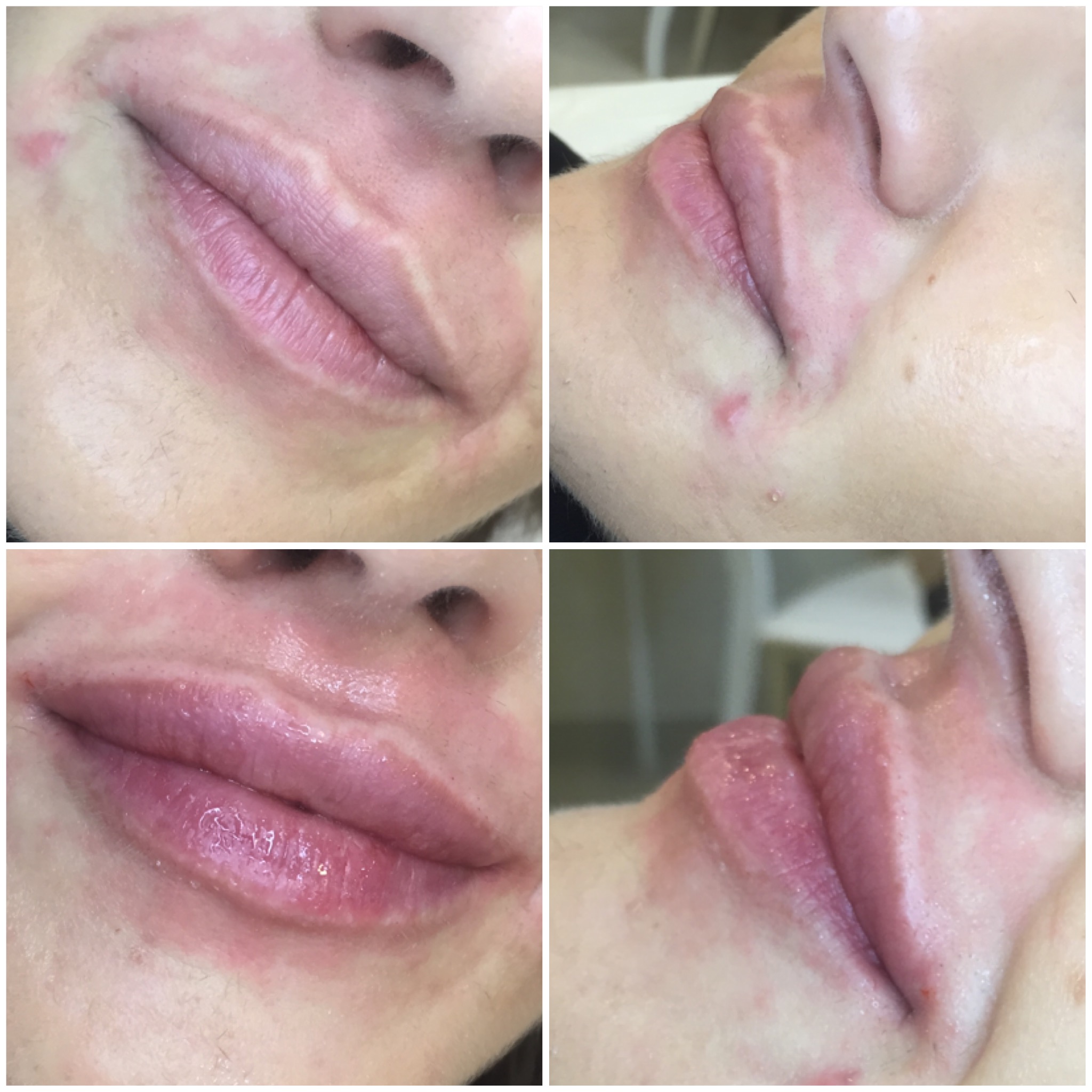 Фото до и после губы гиалуроновой кислотой